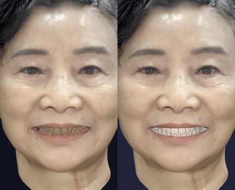 부모님 치아가 걱정된다면 한 번쯤 읽어보세요 — 중년층 구강 변화 이야기 관련 이미지 4