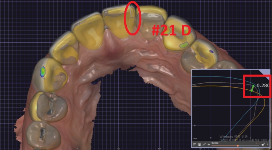 옥니라미네이트, 달라진 미소 [+치료사례 포함] 관련 이미지 13