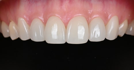 토끼이빨 라미네이트, 이렇게 자연스러워질 수 있습니다 [+치료 사례 포함] 관련 이미지 11