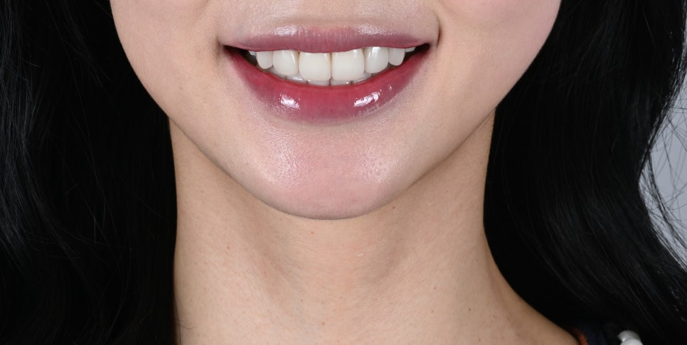 앞니 블랙트라이앵글로 웃음을 잃어버린 당신에게 [+치료 사례 포함] 관련 이미지 10