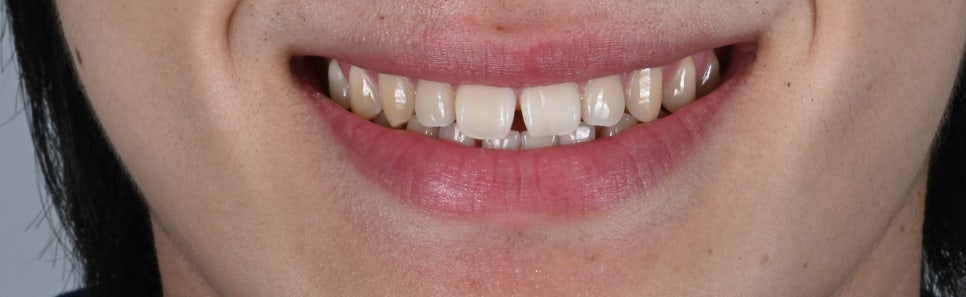 앞니 벌어짐 라미네이트 삭제 걱정 끝 [+치료 사례 포함] 관련 이미지 2