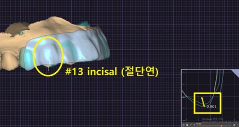 인상이 달라지는 순간, 강남치아미백의 매력 [+치료 사례 포함] 관련 이미지 13