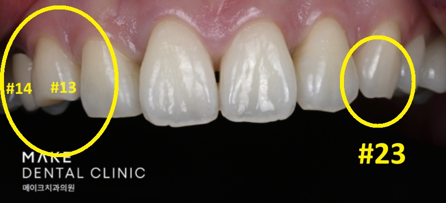 블랙트라이앵글 라미네이트로 완벽한 치아 틈메우기 [ +치료사례 포함] 관련 이미지 10