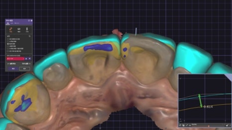 Small Teeth Concerns, Gaining Big Confidence with Small-Tooth Laminates [+Treatment Case Included] image 9