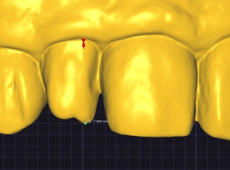 Small Teeth Concerns, Gaining Big Confidence with Small-Tooth Laminates [+Treatment Case Included] image 13