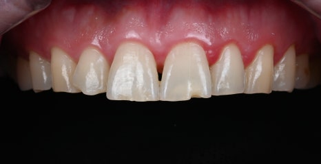 치아 파절 치료하고 다시 웃을 수 있을까요? [+치료 사례 포함] 관련 이미지 7