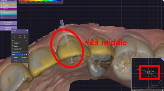 블랙트라이앵글 라미네이트로 완벽한 치아 틈메우기 [ +치료사례 포함] 관련 이미지 9