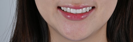 직장인이라면 공감할 고민, 강남치아미백으로 편하게 웃으세요 [+치료 사례 포함] 관련 이미지 10