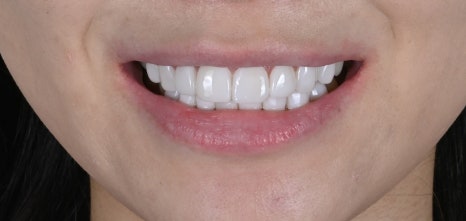 앞니 돌출 라미네이트로 바뀐 일상, 자신감이 달라졌어요 [+치료 사례 포함] 관련 이미지 10