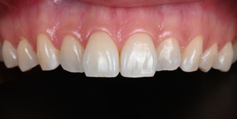 토끼이빨 라미네이트, 이렇게 자연스러워질 수 있습니다 [+치료 사례 포함] 관련 이미지 10