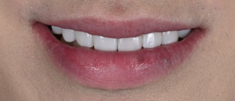 치아미백병원 라미네이트, 조화가 핵심 [+치료 사례 포함] 관련 이미지 3