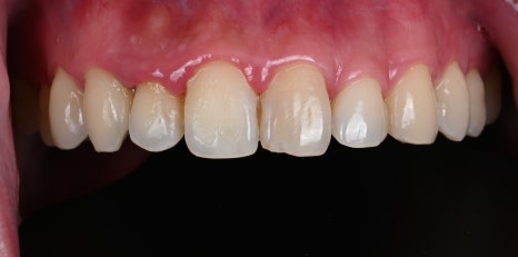 치아미백병원 라미네이트, 조화가 핵심 [+치료 사례 포함] 관련 이미지 10