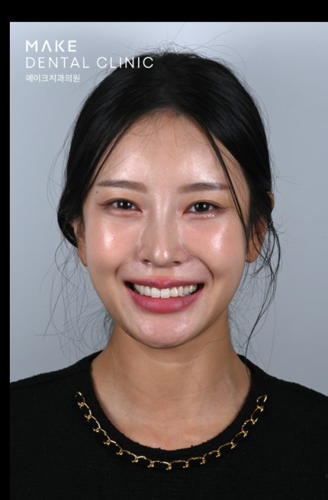 잇몸 라인 비대칭으로 미소의 자신감 회복 [+치료사례 포함] 관련 이미지 3