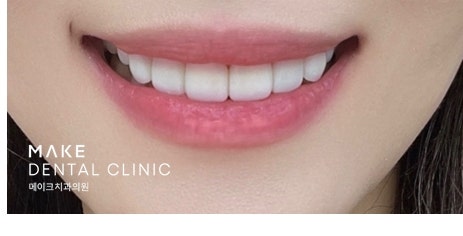 블랙트라이앵글 라미네이트로 완벽한 치아 틈메우기 [ +치료사례 포함] 관련 이미지 15