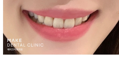 블랙트라이앵글 라미네이트로 완벽한 치아 틈메우기 [ +치료사례 포함] 관련 이미지 3