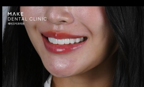 잇몸 라인 비대칭으로 미소의 자신감 회복 [+치료사례 포함] 관련 이미지 17