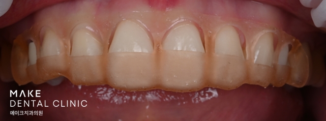 블랙트라이앵글 라미네이트로 완벽한 치아 틈메우기 [ +치료사례 포함] 관련 이미지 12
