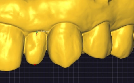 Small Teeth Concerns, Gaining Big Confidence with Small-Tooth Laminates [+Treatment Case Included] image 17