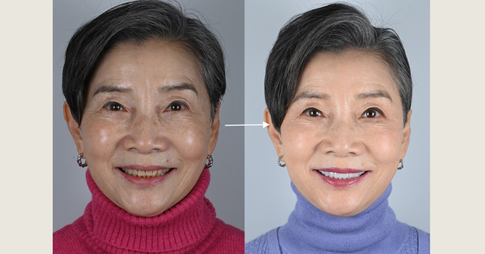 부모님 치아가 걱정된다면 한 번쯤 읽어보세요 — 중년층 구강 변화 이야기 관련 이미지 1