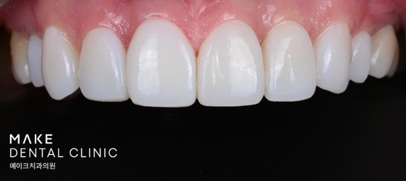 블랙트라이앵글 라미네이트로 완벽한 치아 틈메우기 [ +치료사례 포함] 관련 이미지 14