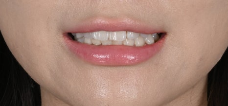 앞니 돌출 라미네이트로 바뀐 일상, 자신감이 달라졌어요 [+치료 사례 포함] 관련 이미지 9