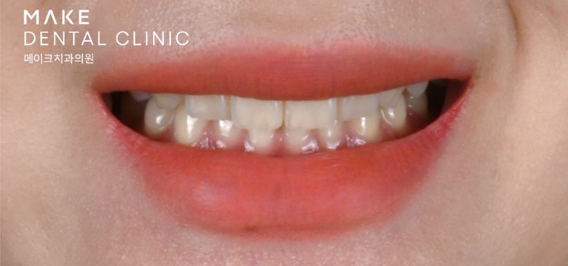 옥니라미네이트, 달라진 미소 [+치료사례 포함] 관련 이미지 4