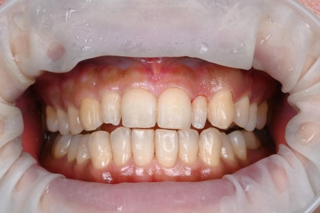 Small Teeth Concerns, Gaining Big Confidence with Small-Tooth Laminates [+Treatment Case Included] image 12