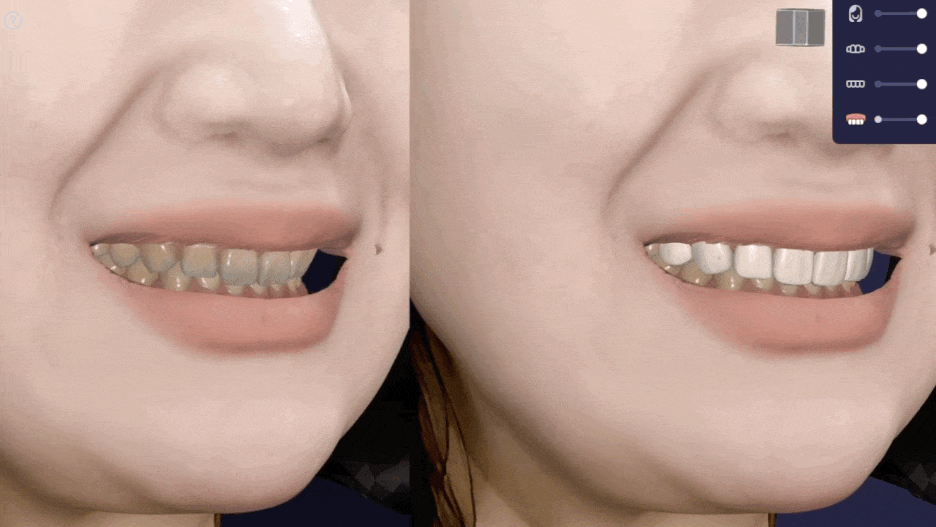 옥니라미네이트, 달라진 미소 [+치료사례 포함] 관련 이미지 8