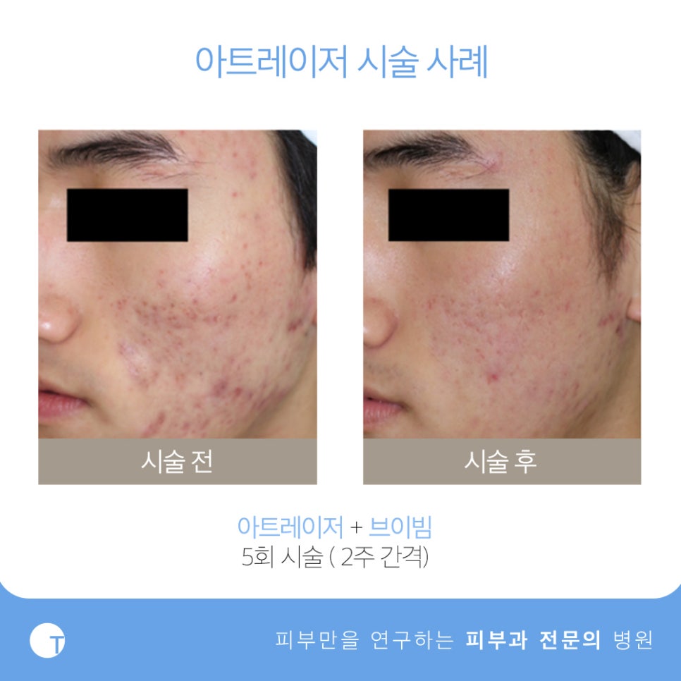 역삼역여드름 아트레이저로 관리해요 관련 이미지 7