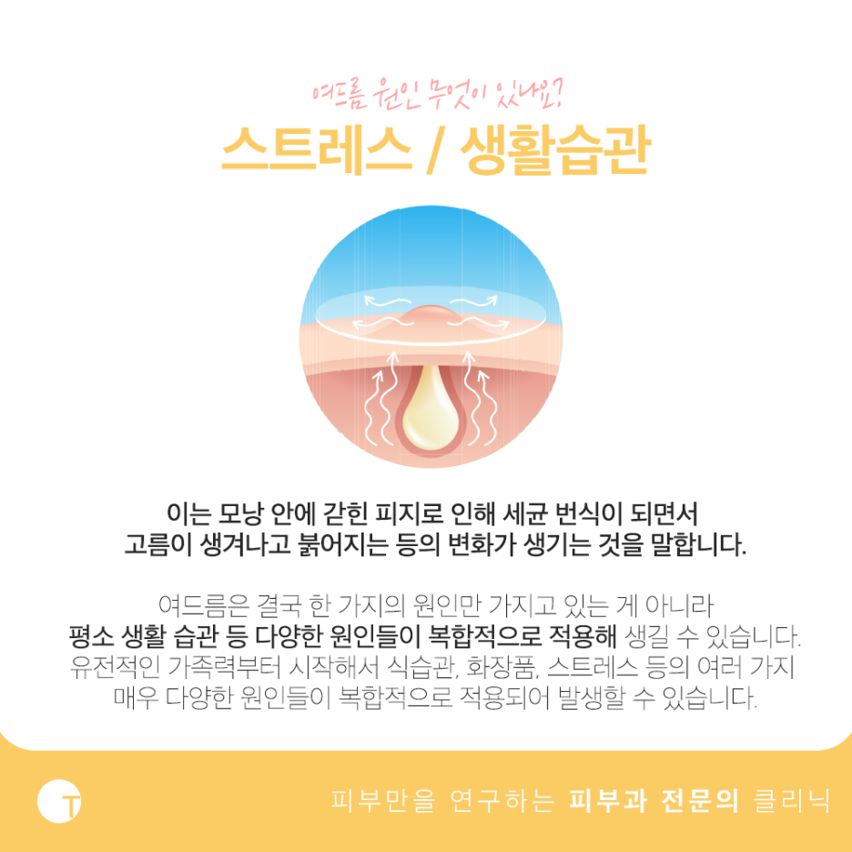 여드름 원인 궁금하다면 관련 이미지 2