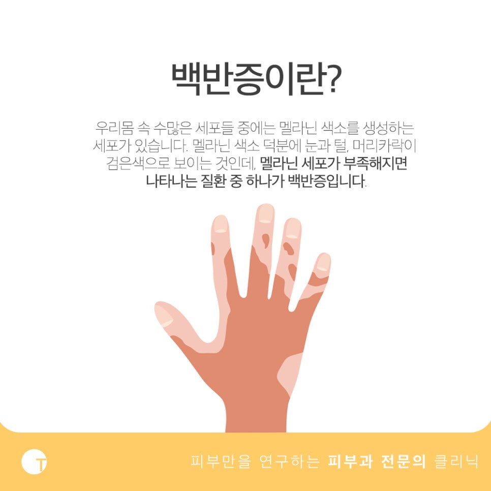 백반증 해결하기 위해서는 관련 이미지 2