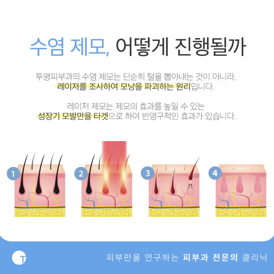 역삼역수염제모 레이저로 깔끔하게 관련 이미지 2