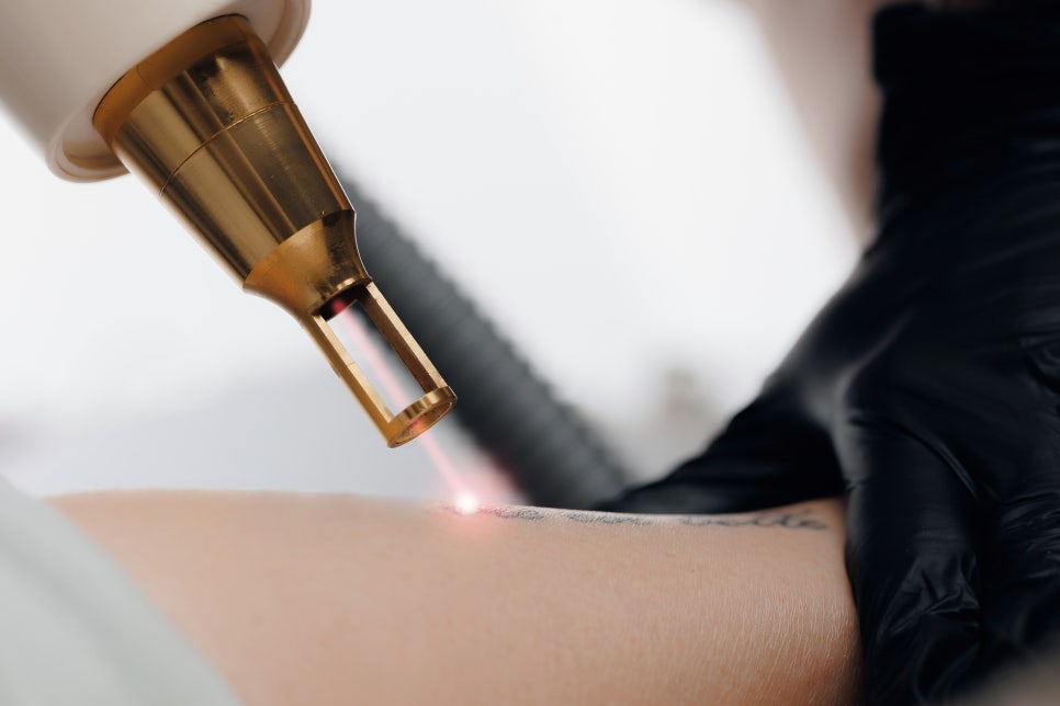 Choosing Tattoo Removal Near Yeoksam Station Carefully image 1