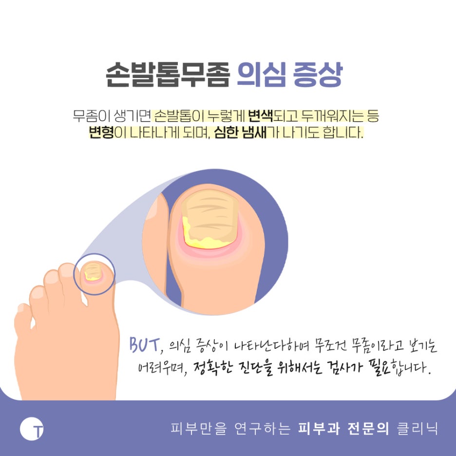 손발톱무좀 신속면역검사 빠르고 정확하게 관련 이미지 2