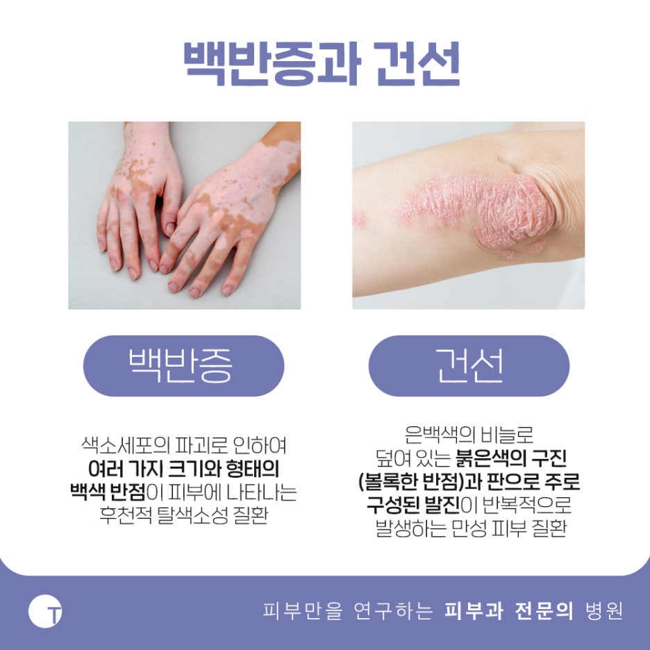 역삼동백반증치료 필라스레이저로 관련 이미지 2