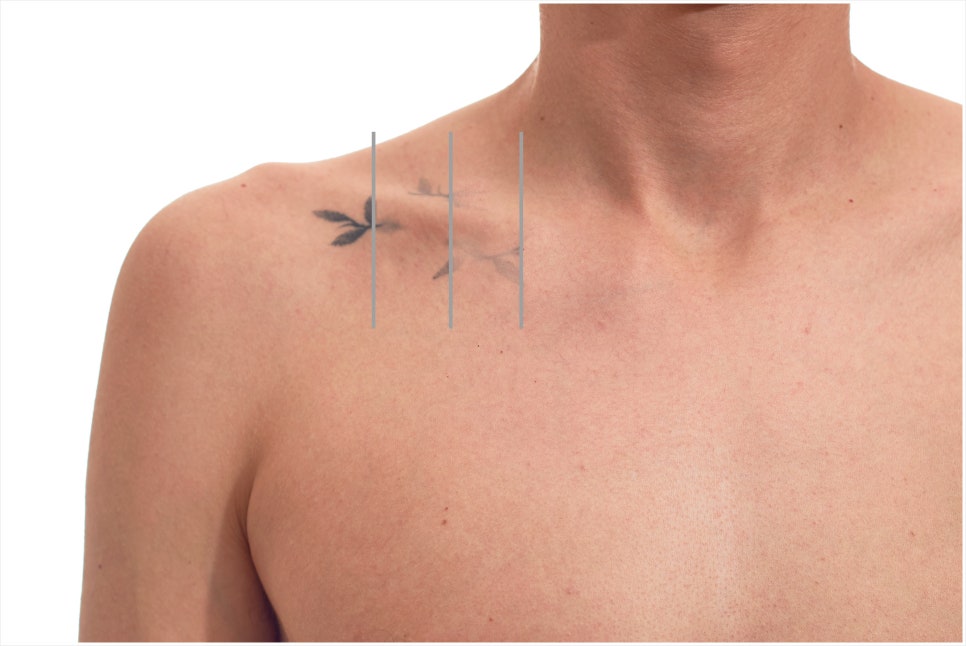 Why You Should Get Tattoo Removal at a Place That Specializes in Gangnam Yeoksam Tattoo Removal image 3