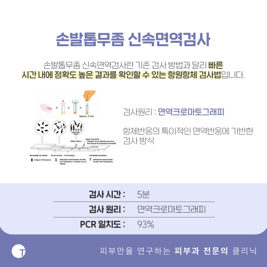 손발톱무좀 신속면역검사 빠르고 정확하게 관련 이미지 4