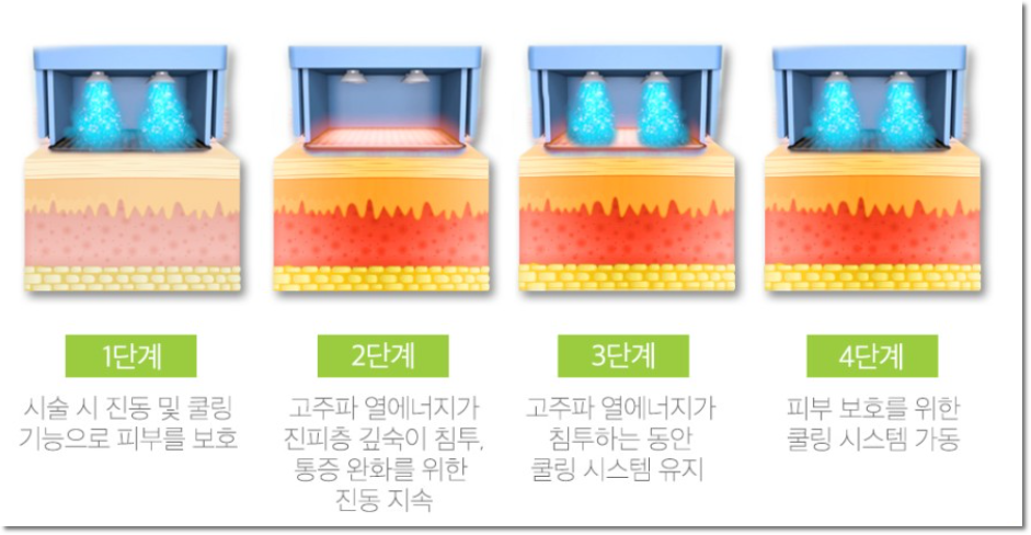 역삼동피부과추천 써마지의 일회용의 팁으로 관련 이미지 3
