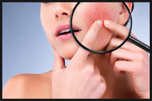How Can Gangnam Yeoksam V-Beam Help with Facial Redness? image 4
