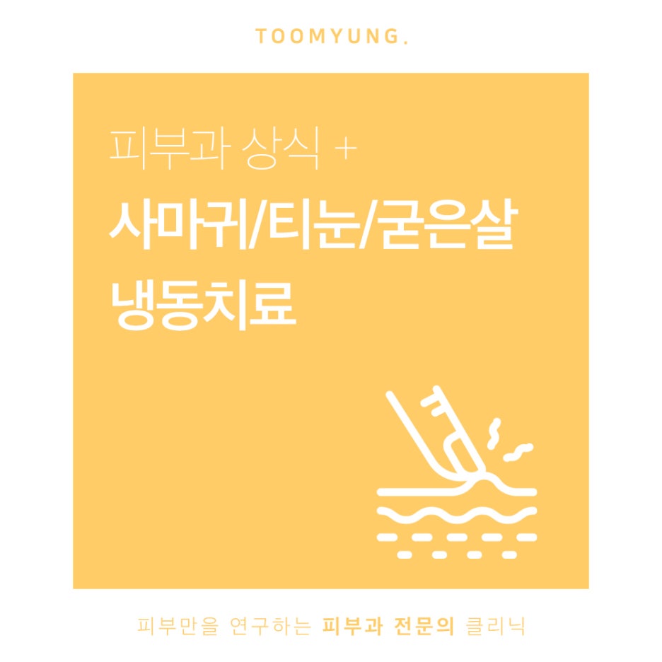 사마귀 티눈 냉동치료 방식과 장점은 관련 이미지 1