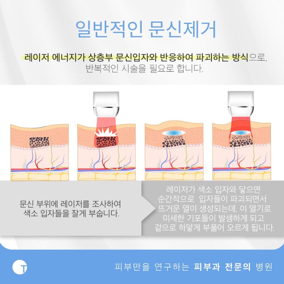 역삼동문신제거 피부손상은 줄이고 효과는 높이고 관련 이미지 3