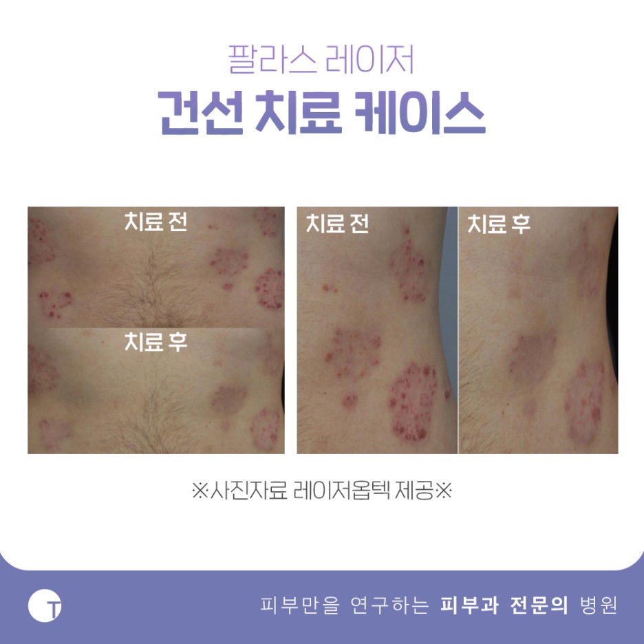 역삼동백반증치료 필라스레이저로 관련 이미지 10