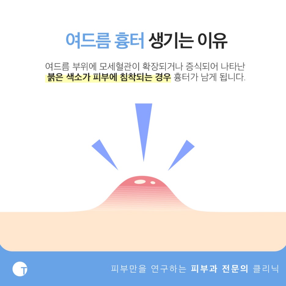 역삼피부과 LDM노블레스로 깨끗한 피부를 관련 이미지 2