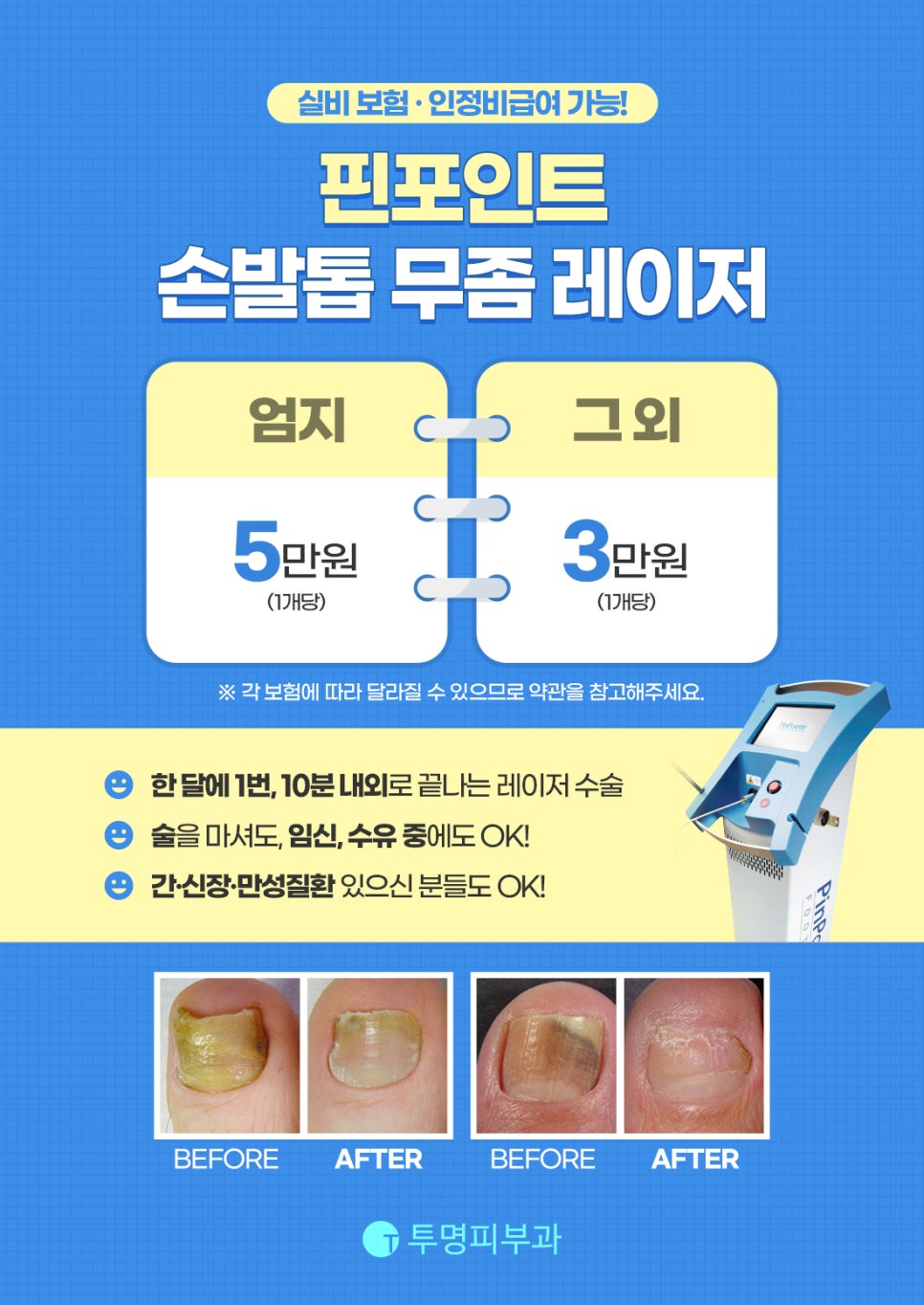 핀포인트 손발톱 무좀 레이저 안내드려요! 관련 이미지 1