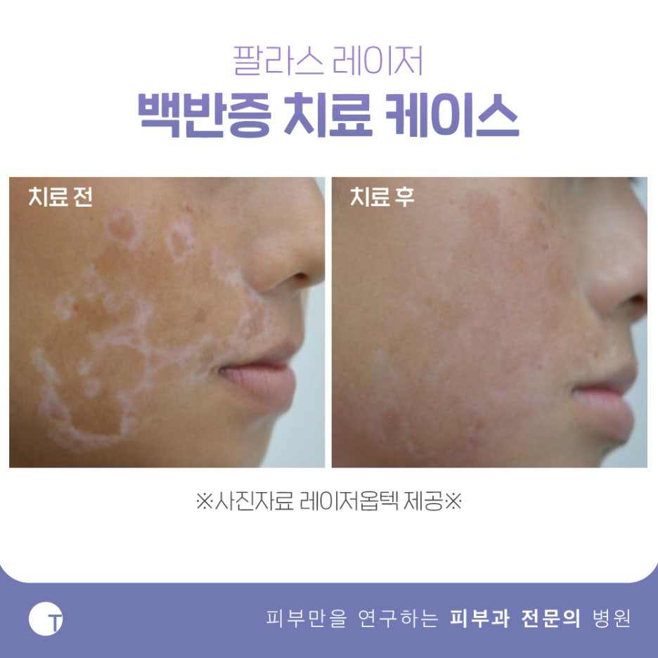 역삼동백반증치료 필라스레이저로 관련 이미지 11