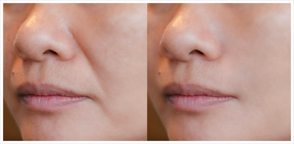 Recommended Sculptra in Gangnam: Natural Volume at Transparent Dermatology! image 1