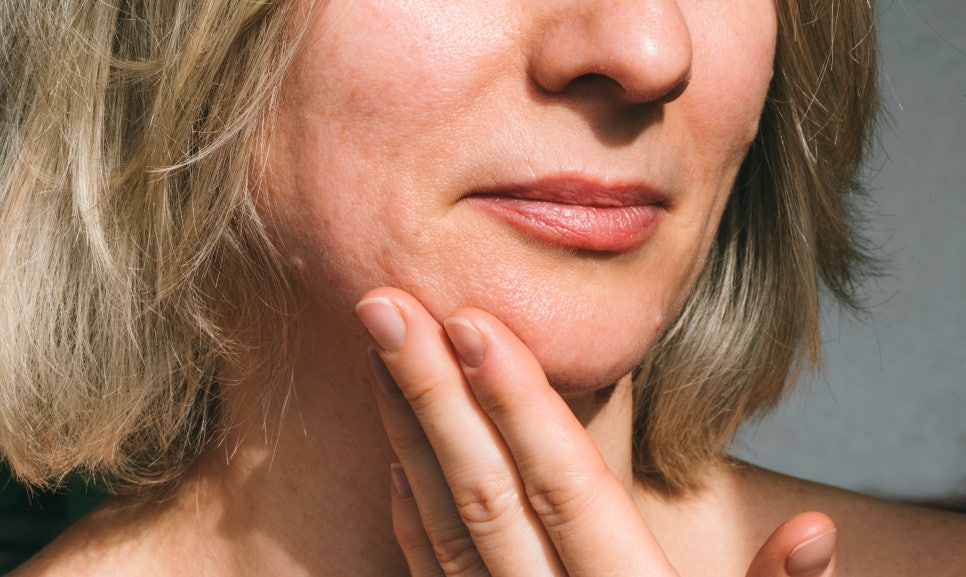 A Treatment That Can Improve Multiple Concerns at Once Near Yeoksam Station Restylane Vital image 1