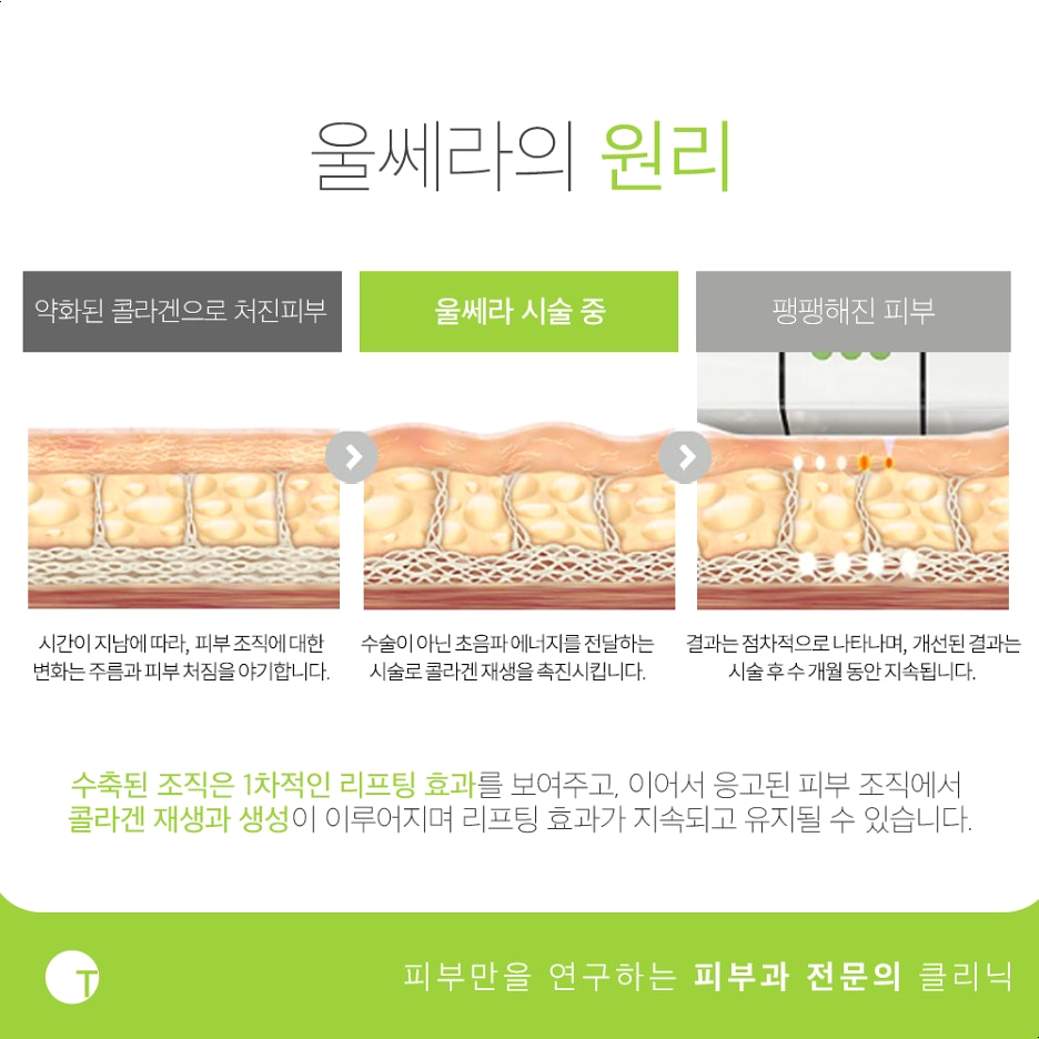 역삼울쎄라 탄력을 채워주는 관련 이미지 2