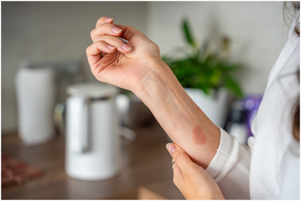 Are You Looking for a Gangnam Burn Treatment Dermatology Clinic? Before Scarring Occurs image 1