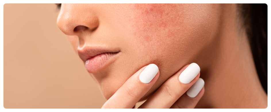 If You’re Stressed by Acne Scars, Yeoksam Gold PTT image 1